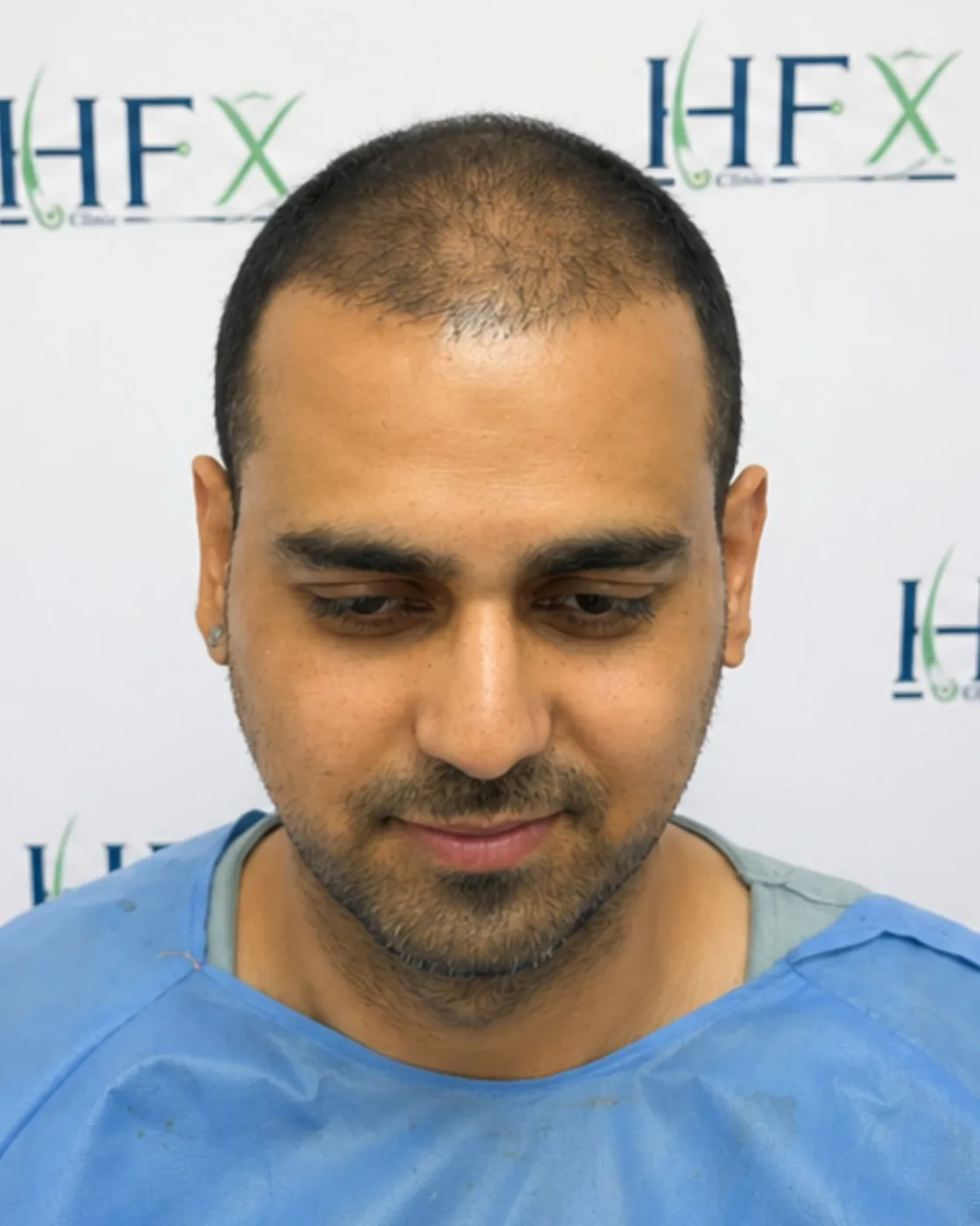 Before treatment - Nitish
