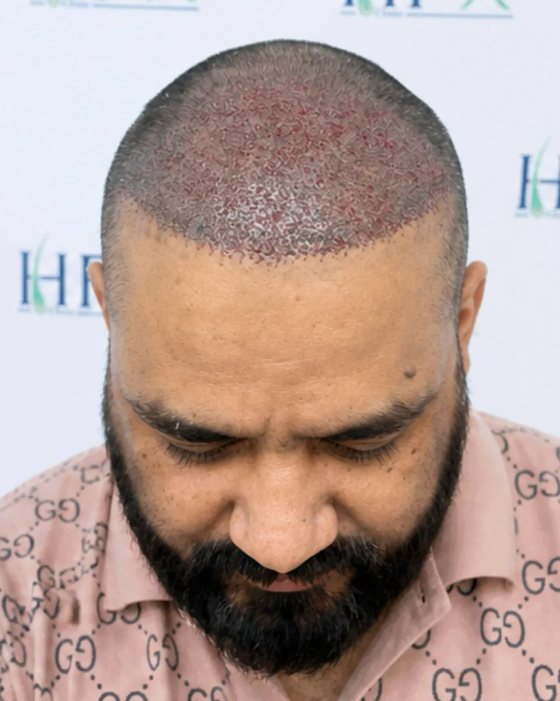 After treatment - Abdullah